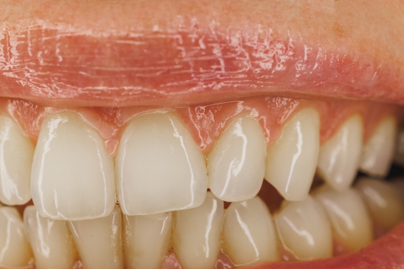 diferencia entre gingivitis y periodontitis