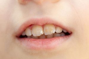 manchas blancas en los dientes