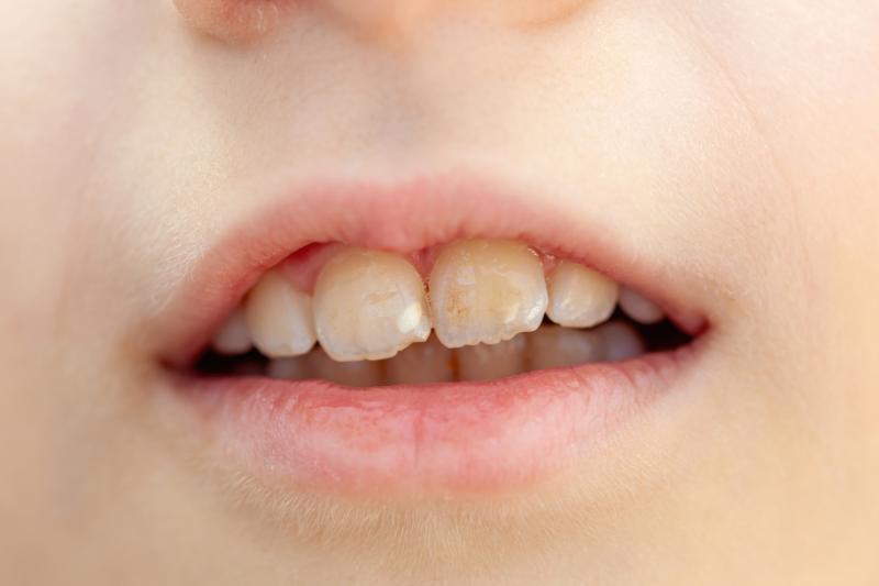 manchas blancas en los dientes