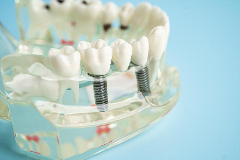 ¿Qué pasa si no me pongo un implante dental tras perder un diente?