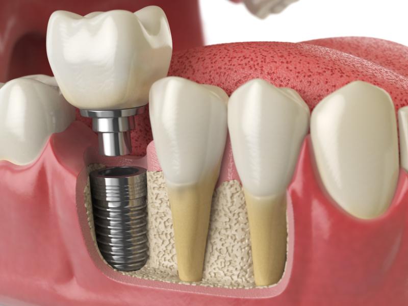 Síntomas rechazo implante dental
