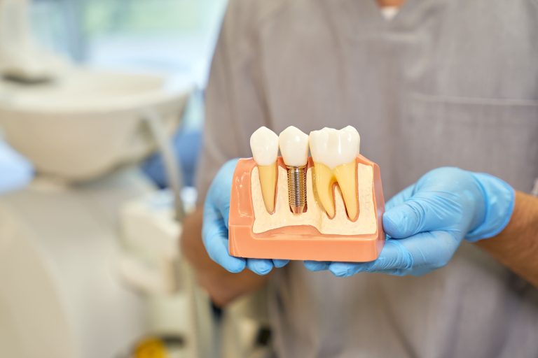 implantes dentales en Móstoles