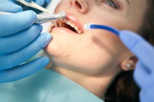manchas marrones en los dientes