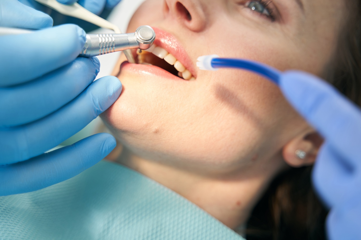 manchas marrones en los dientes