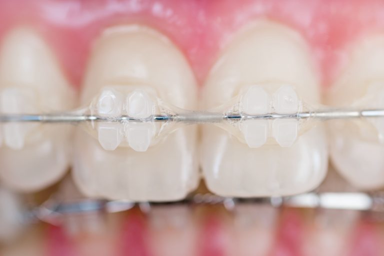 Precio de los brackets de cerámica en Fuenlabrada