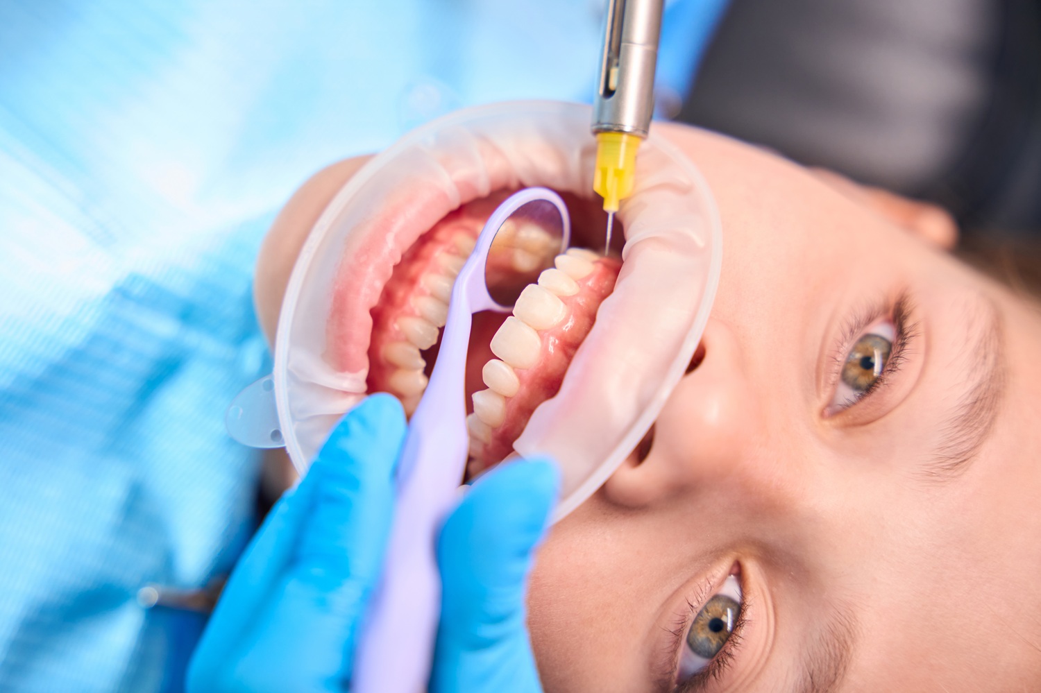 Rechazo infección implante dental síntomas